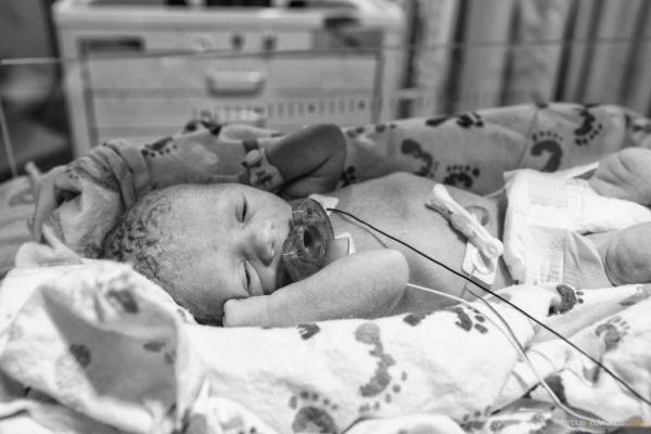 Μια επείγουσα καισαρική σε… εικόνες! | imommy.gr