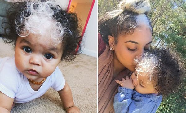 Κοριτσάκι γεννήθηκε με μια λευκή τούφα στα μαλλιά | imommy.gr