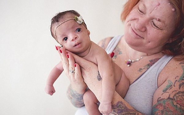 Κοριτσάκι εγκαταλείφθηκε από τους θετούς γονείς της επειδή γεννήθηκε με μια σπάνια πάθηση. | imommy.gr