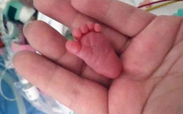 Την λένε Emilia και είναι το μικρότερο επιζών πρόωρο μωρό στον κόσμο! (Εικόνες) | imommy.gr
