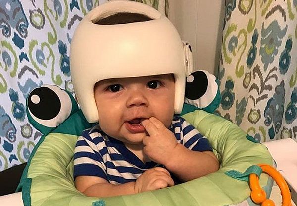 Μωρό έπρεπε να φοράει κράνος. Δείτε πως αντέδρασε η οικογένειά του | imommy.gr