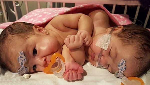 Γεννήθηκαν ενωμένα… με μία καρδιά. Ο διαχωρισμός τους αποτέλεσε ιατρικό επίτευγμα! | imommy.gr