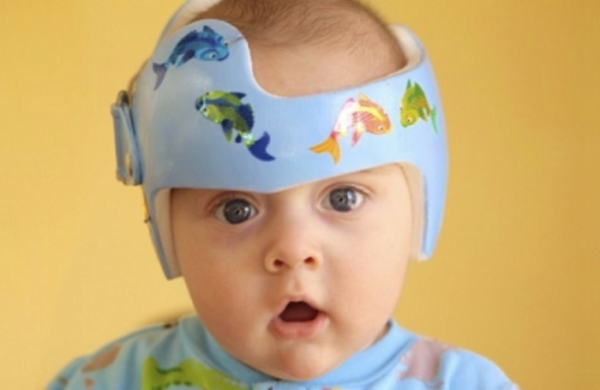 Πλαγιοκεφαλία στα βρέφη: Πως να την προλάβετε και πώς να την θεραπεύσετε | imommy.gr