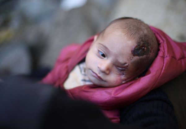 Μωράκι 2 μηνών χάνει το μάτι του σε βομβαρδισμό στη Συρία-Δείτε το κύμα συμπαράστασης | imommy.gr