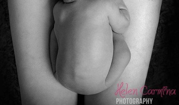 Γέννησα το μωρό μου με καισαρική και δε ντρέπομαι γι’ αυτό! | imommy.gr