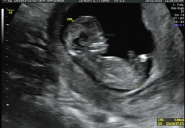 Είστε έγκυος; Δείτε τι συμβαίνει στο μωρό σας όταν φτερνίζεστε (βίντεο) | imommy.gr