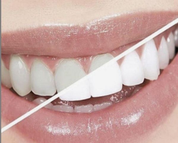 Τα επτά εύκολα βήματα για λευκά δόντια | imommy.gr
