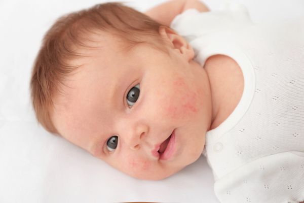 Μήπως το μωρό έχει αλλεργία; | imommy.gr