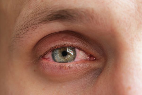 Κοροναϊός: Μπορεί να προκαλέσει μόλυνση στα μάτια; | imommy.gr