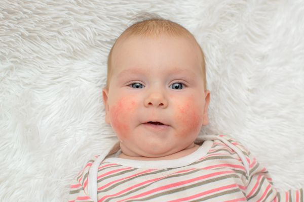 Παιδί: Έτσι θα μειώσετε τον κίνδυνο να αναπτύξει τροφική αλλεργία | imommy.gr
