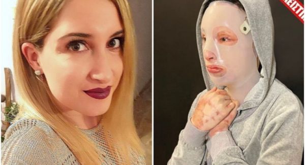 Επίθεση με βιτριόλι: Μετά το 8ο χειρουργείο, η Ιωάννα δείχνει τα εγκαύματα στο χέρι της | imommy.gr