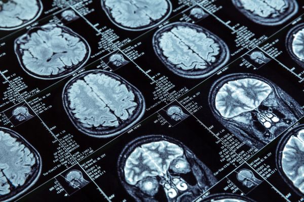 Αισιόδοξα νέα: Θεραπεία νέου τύπου για όγκους στον εγκέφαλο | imommy.gr